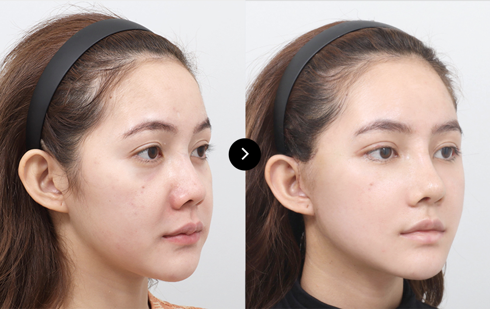 before & after