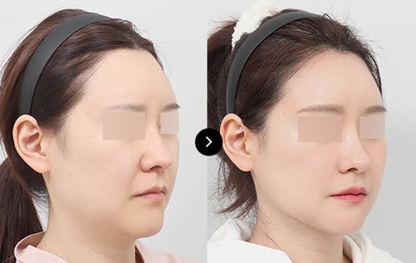 before & after