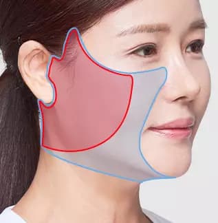 Full SMAS Facelift