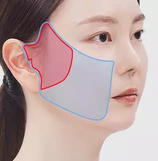 Midface Semi-Full Facelift