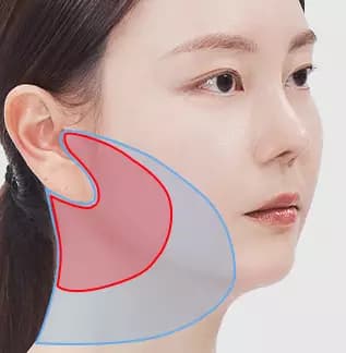 Lower Face Semi-Full Facelift