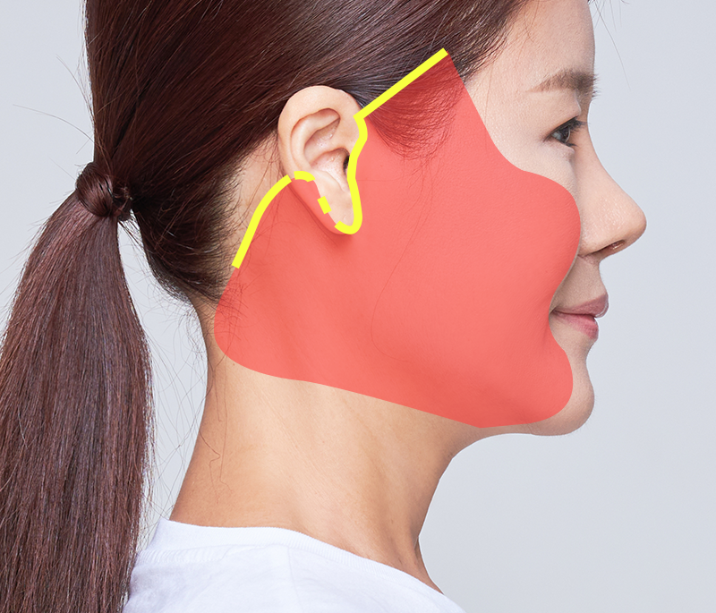 Facelift dissection technique point 1: Dissecting a wide area meticulously to achieve a strong lifting effect without side effects