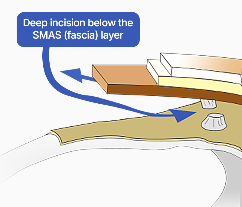 Facelift dissection technique point 2: Avoiding nerves and blood vessels, precisely cutting the retaining ligaments in each area for long-lasting effects.