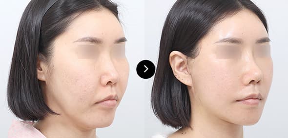 Semi-Face Lifting image 2