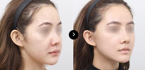 Semi-Face Lifting image 3