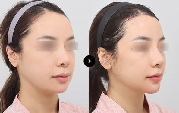 Mini Incision Face Lifting image 2