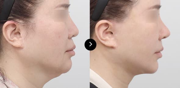 Neck Lifting image 3