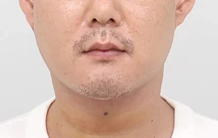 After 1 week