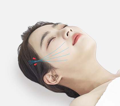 Anti Aging Thread Lift image