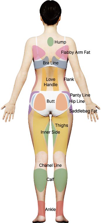 Back view liposuction surgical areas diagram