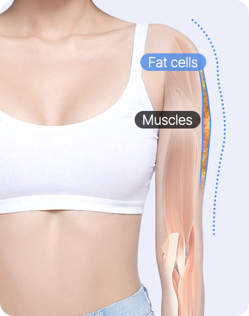 A delicate right-angle shoulder with "I-line" arm liposuction before liposuction comparison