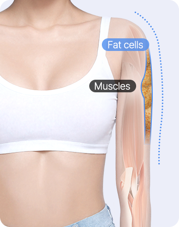 A delicate right-angle shoulder with "I-line" arm liposuction after AB liposuction comparison