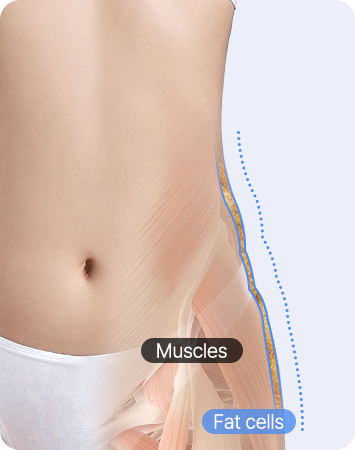 Ant Waist & Cola Bottle Curve Abdominal Liposuction before liposuction comparison