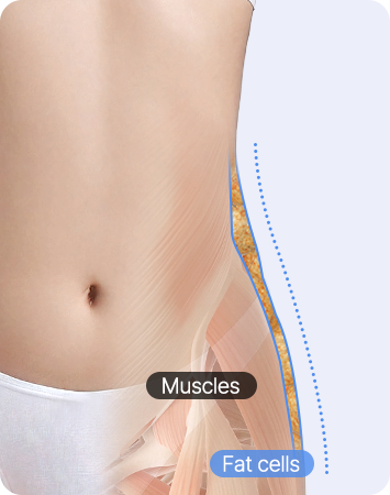 Ant Waist & Cola Bottle Curve Abdominal Liposuction after AB liposuction comparison