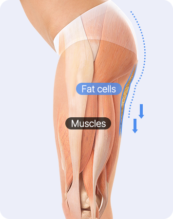 Apple Hip Line Liposuction before liposuction comparison