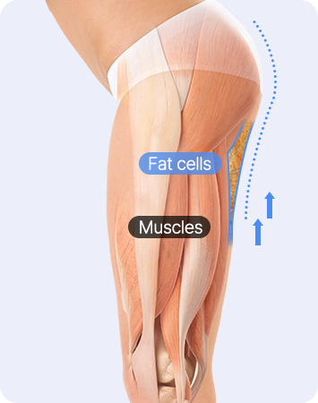 Apple Hip Line Liposuction after AB liposuction comparison