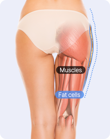 Thigh liposuction for idol-like proportions and straight legs before liposuction comparison