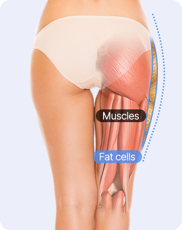 Thigh liposuction for idol-like proportions and straight legs after AB liposuction comparison