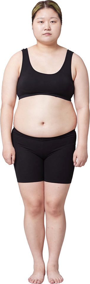 Before liposuction body composition example