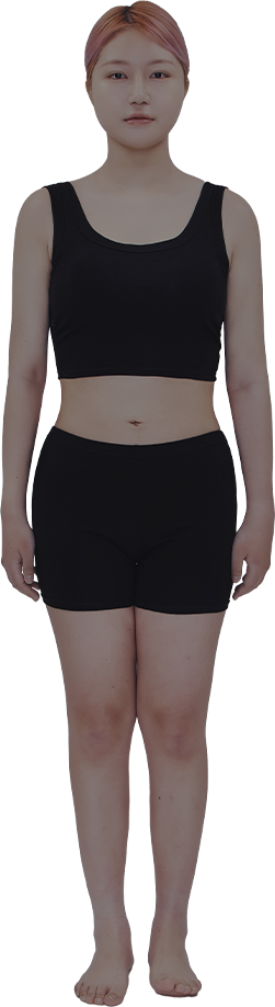 After liposuction body composition example