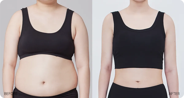 Size 44 liposuction body line example