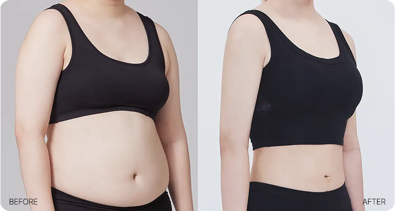 Plus-size liposuction body line example