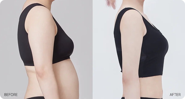 AB liposuction body contour transformation example