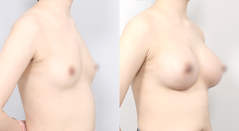 Breast Mento Breast Implants Surgery Slide image