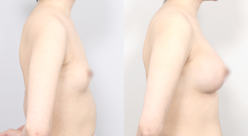 Breast Mento Breast Implants Surgery Slide image