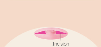 Breast Nipple Surgery image