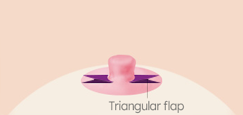 Breast Nipple Surgery image