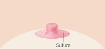 Breast Nipple Surgery image
