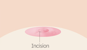 Breast Nipple Surgery image