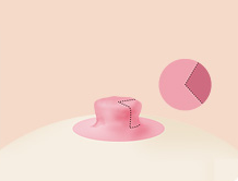 Breast Nipple Surgery image