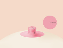 Breast Nipple Surgery image
