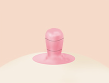 Breast Nipple Surgery image