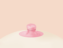 Breast Nipple Surgery image