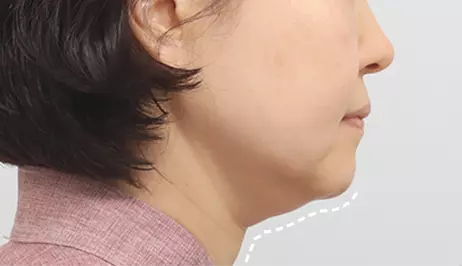 Submentoplasty before surgery
