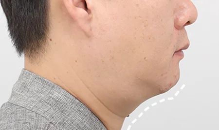 Submentoplasty before surgery