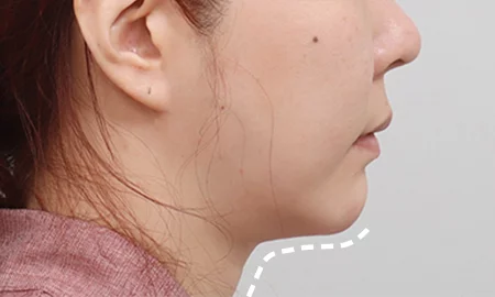 Submentoplasty before surgery