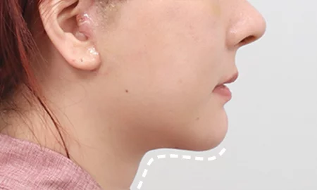 Submentoplasty 2 weeks after surgery
