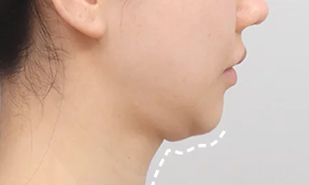 Submentoplasty with salivary gland removal before surgery