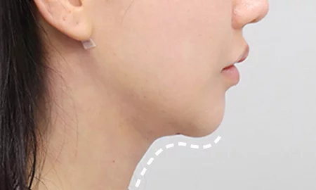 Submentoplasty with salivary gland removal 1 week after surgery