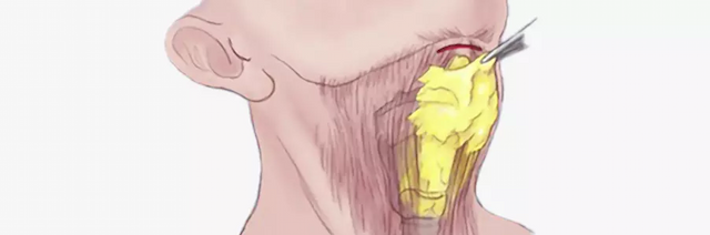 Fat removal from subcutaneous layer beneath platysma muscle