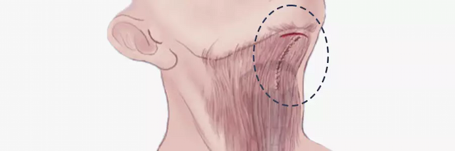 Platysma muscle tightening procedure