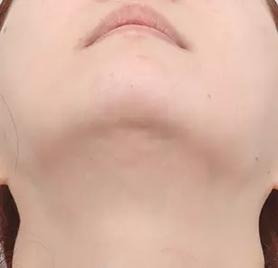Incisional scar before treatment
