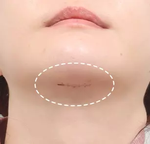 Incisional scar after 2 weeks
