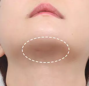 Incisional scar after 1 month