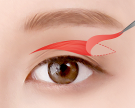 Eye Middle Age Eyelid Upper Blepharoplasty image