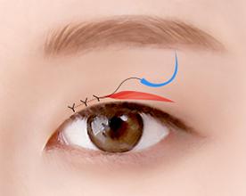 Eye Middle Age Eyelid Upper Blepharoplasty image